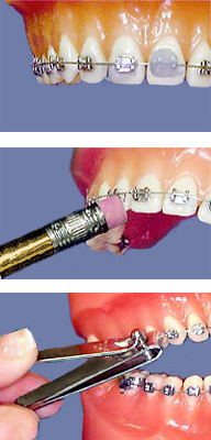 Emergencies  Soriano Orthodontics