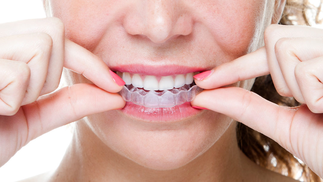 For Adults, Invisalign is a Perfect Choice to “Tune Up” Your Teeth